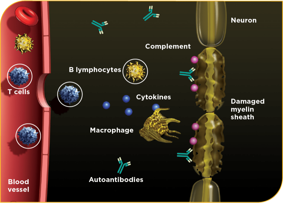 Elements of CIDP