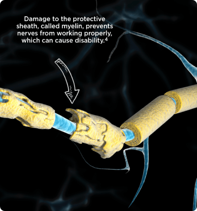 Nerve damage from CIDP